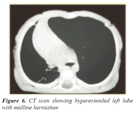 currentpediatrics-midline-herniation