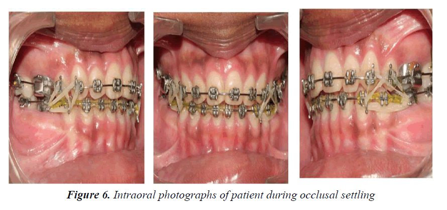 currentpediatrics-occlusal-settling