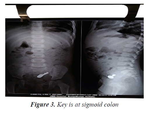 currentpediatrics-sigmoid-colon