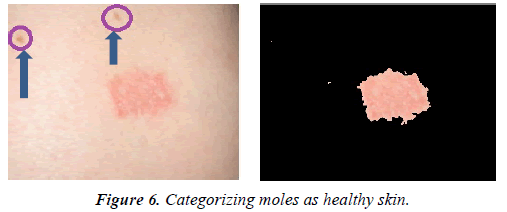 dermatology-research-skin-care-Categorizing-moles