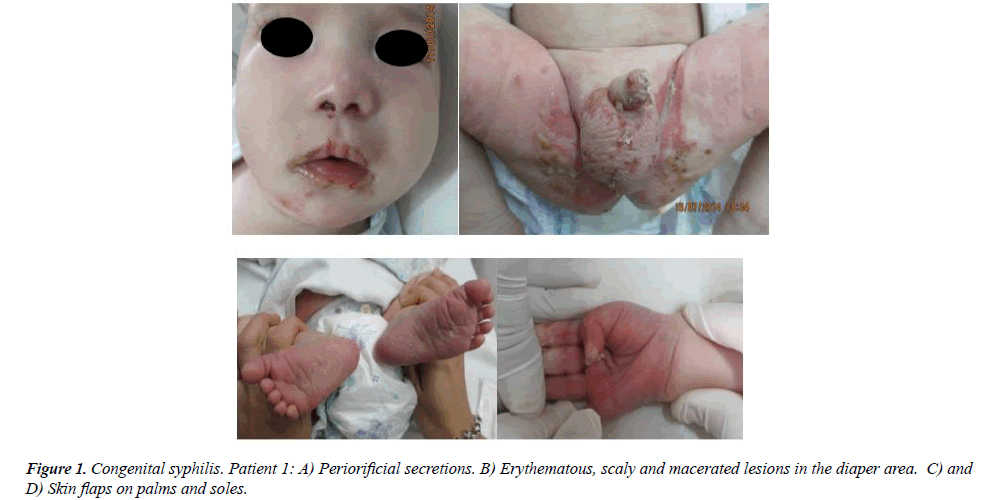 saddle nose syphilis baby