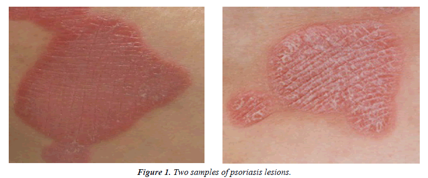 dermatology-research-skin-care-psoriasis-lesions