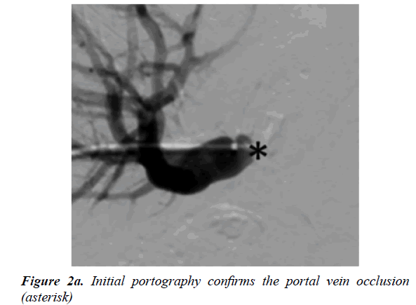 gastroenterology-and-digestive-diseases-Initial-portography-confirms-portal-veins