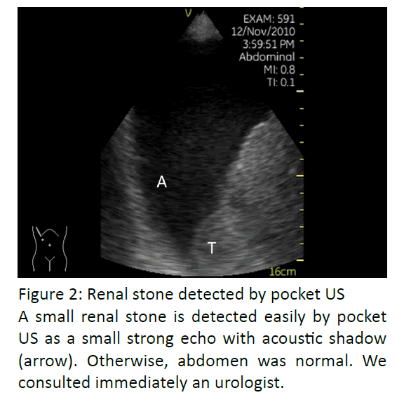 gastroenterology-and-digestive-diseases-Renal-stone-detected