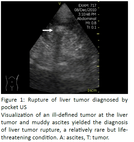 gastroenterology-and-digestive-diseases-Rupture-liver-tumor