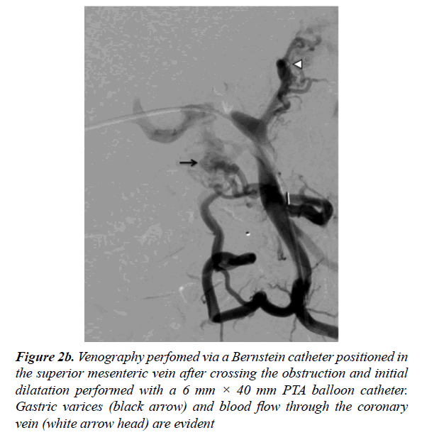 gastroenterology-and-digestive-diseases-Venography-perfomed-Bernstein-catheter