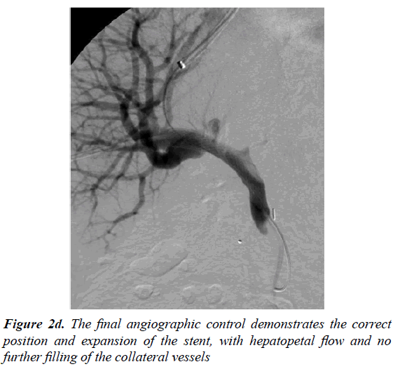 gastroenterology-and-digestive-diseases-angiographic-control-demonstrates