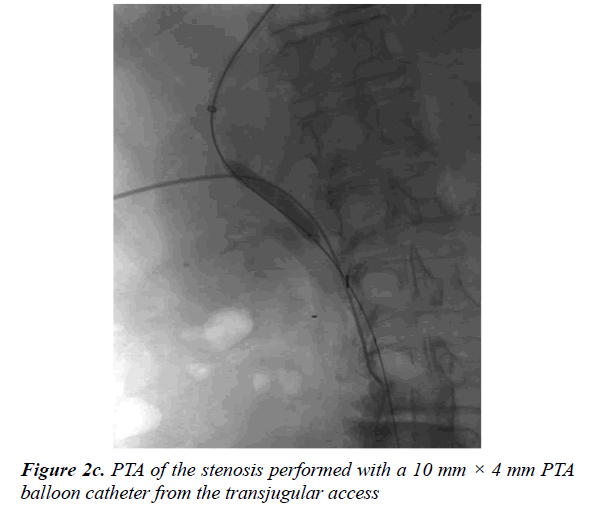 gastroenterology-and-digestive-diseases-balloon-catheter-transjugular-access