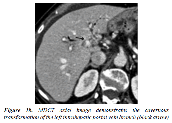 gastroenterology-and-digestive-diseases-demonstrates-cavernous-transformation