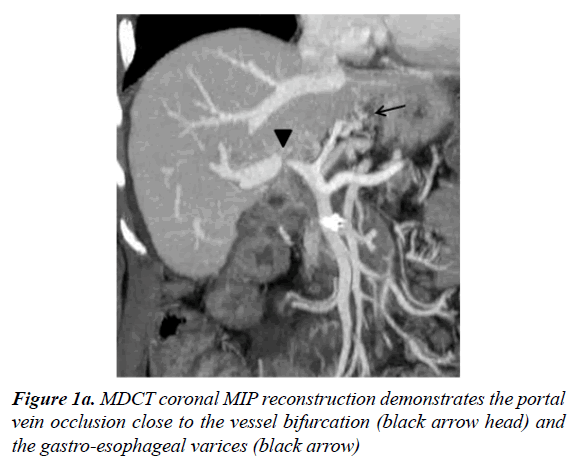 gastroenterology-and-digestive-diseases-portal-vein-occlusion-1-2-010-g001a.png