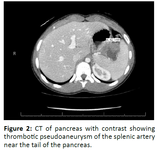 gastroenterology-and-digestive-diseases-thrombotic-pseudoaneurysm-splenic