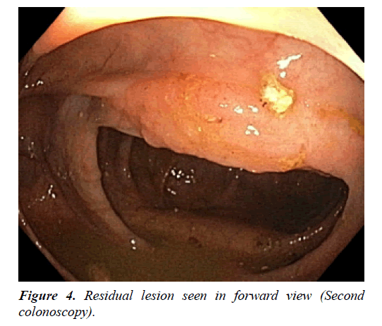 gastroenterology-digestive-disease-Residual-lesion