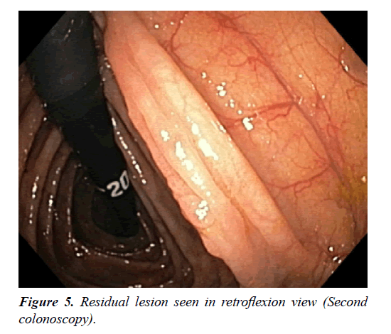 gastroenterology-digestive-disease-retroflexion-view