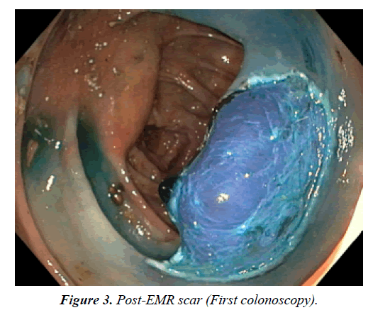 gastroenterology-digestive-disease-scar