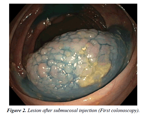 gastroenterology-digestive-disease-submucosal-injection