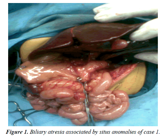 gastroenterology-digestive-diseases-Biliary-atresia