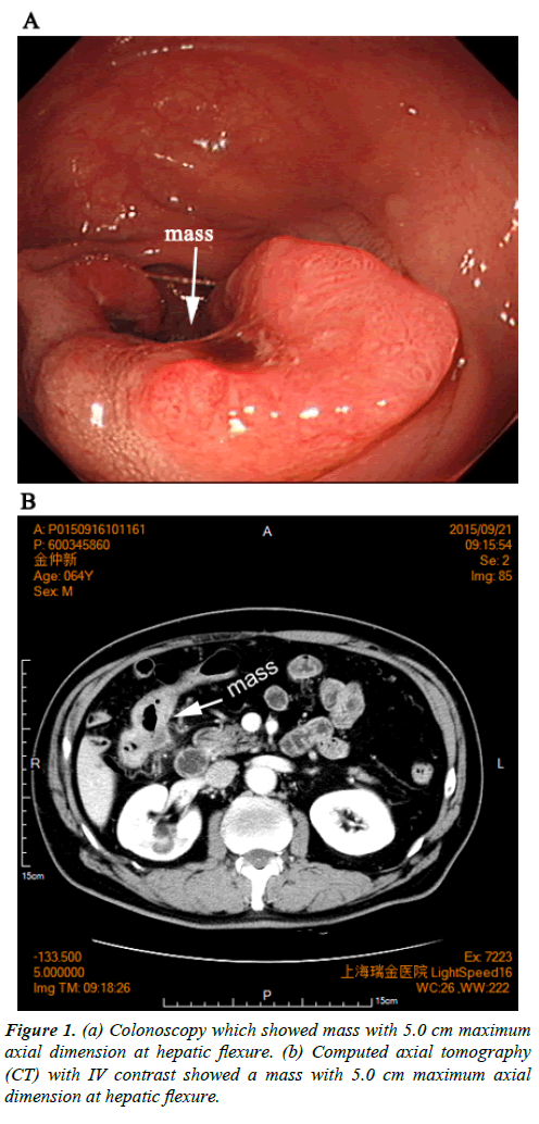 gastroenterology-digestive-diseases-Colonoscopy-hepatic-flexure