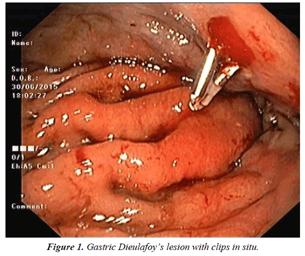 gastroenterology-digestive-diseases-Gastric-Dieulafoy