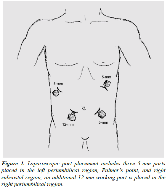 gastroenterology-digestive-diseases-Laparoscopic-port