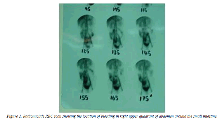 gastroenterology-digestive-diseases-Radionuclide-RBC-scan