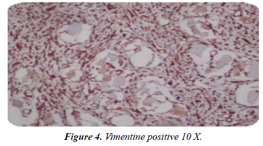 gastroenterology-digestive-diseases-Vimentine-positive