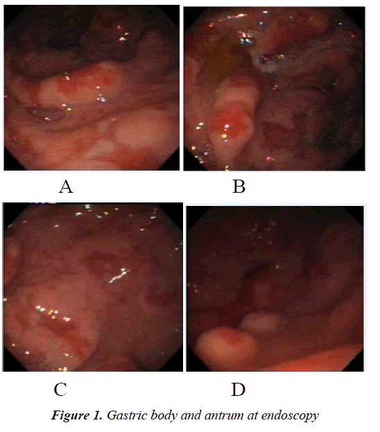 gastroenterology-digestive-diseases-antrum-endoscopy