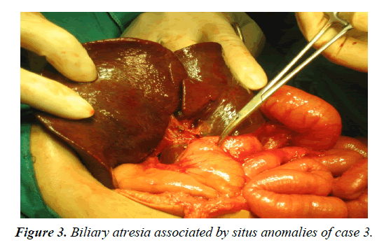 gastroenterology-digestive-diseases-atresia-associated