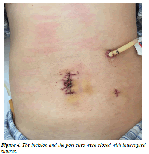 gastroenterology-digestive-diseases-incision-port-sites