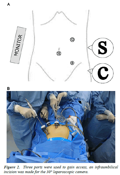 gastroenterology-digestive-diseases-infraumbilical-incision-laparoscopic-camera