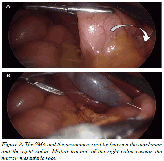 gastroenterology-digestive-diseases-mesenteric-root