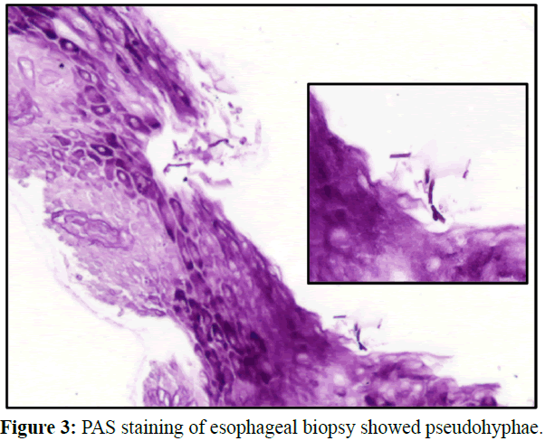 gastroenterology-digestive-diseases-staining-esophageal-biopsy