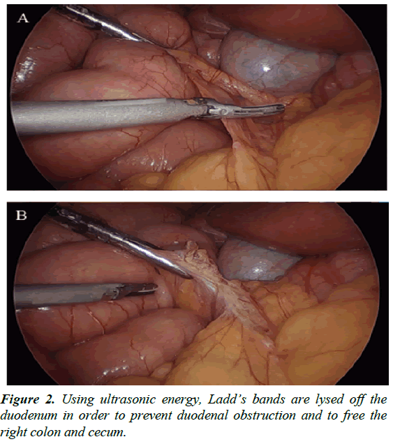 gastroenterology-digestive-diseases-ultrasonic-energy