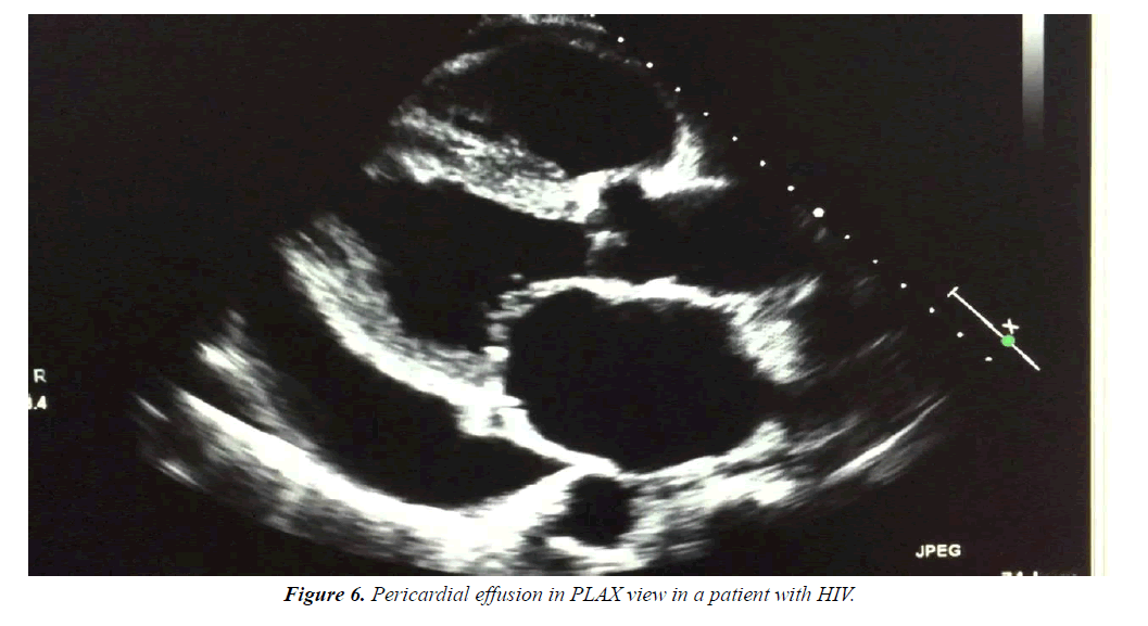 general-internal-medicine-Pericardial-effusion