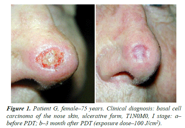 general-internal-medicine-basal-cell