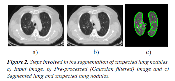 general-internal-medicine-lung-nodules