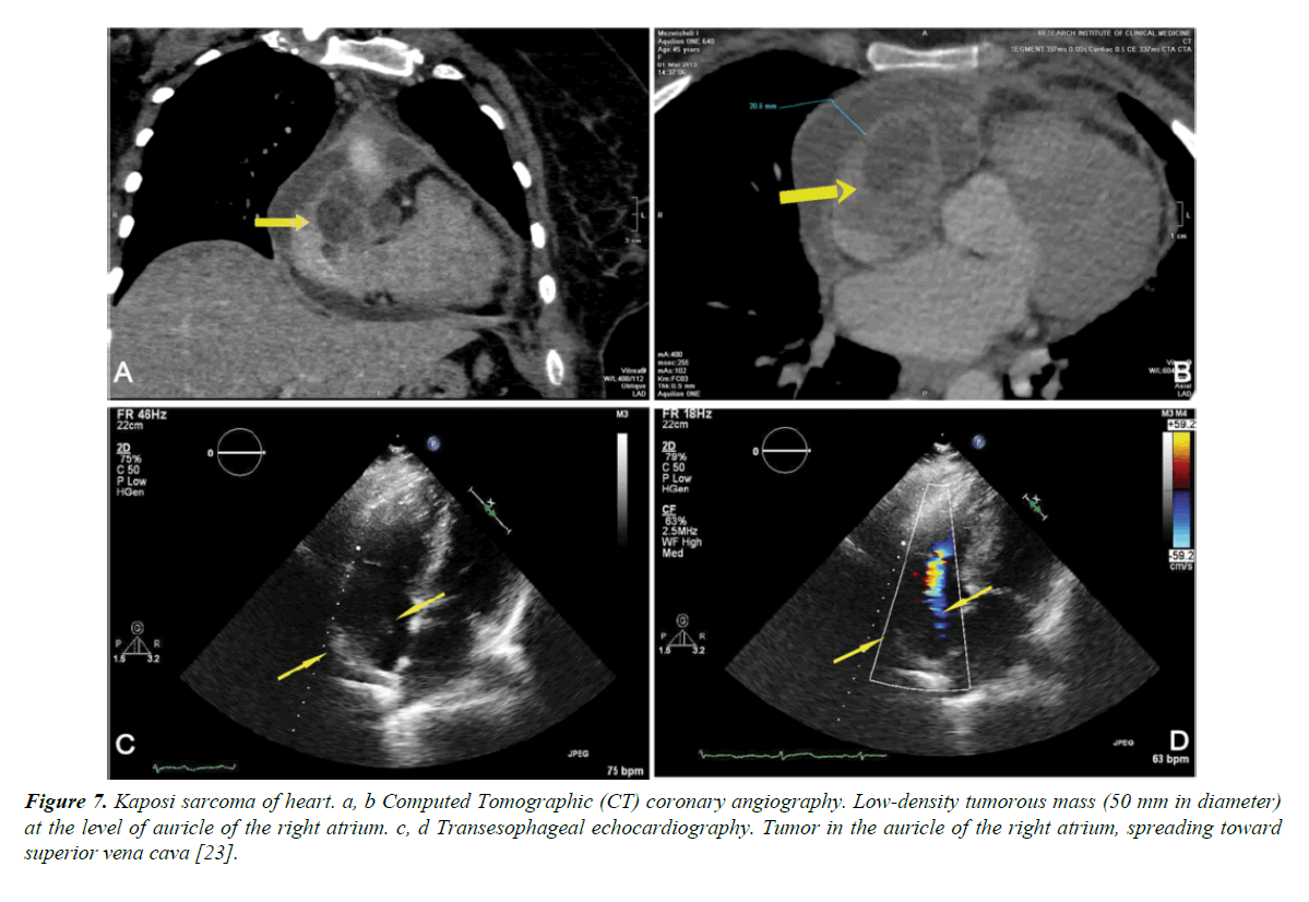 general-internal-medicine-sarcoma-heart