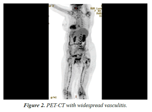 general-internal-medicine-widespread-vasculitis