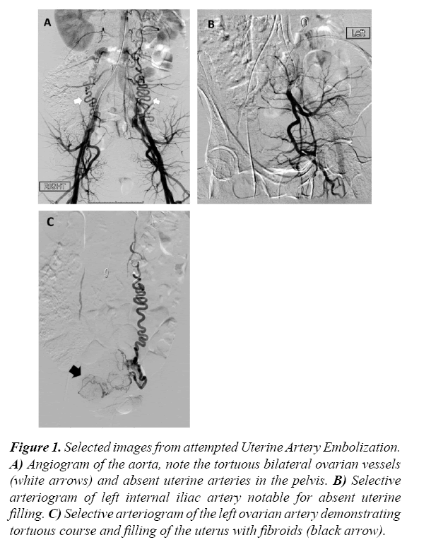 gynecology-obstetrics-artery-embolization