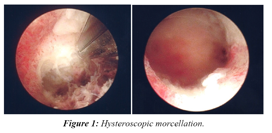 gynecology-obstetrics-hysteroscopic-morcellation