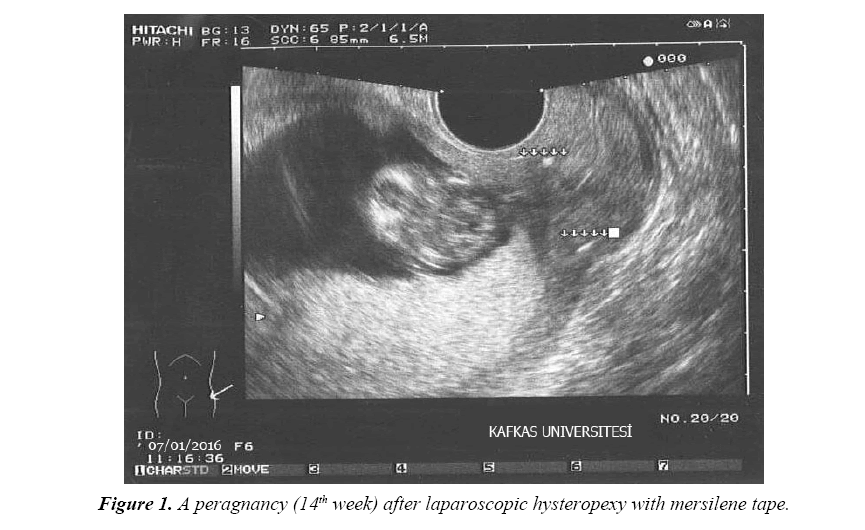 gynecology-obstetrics-laparoscopic-hysteropexy