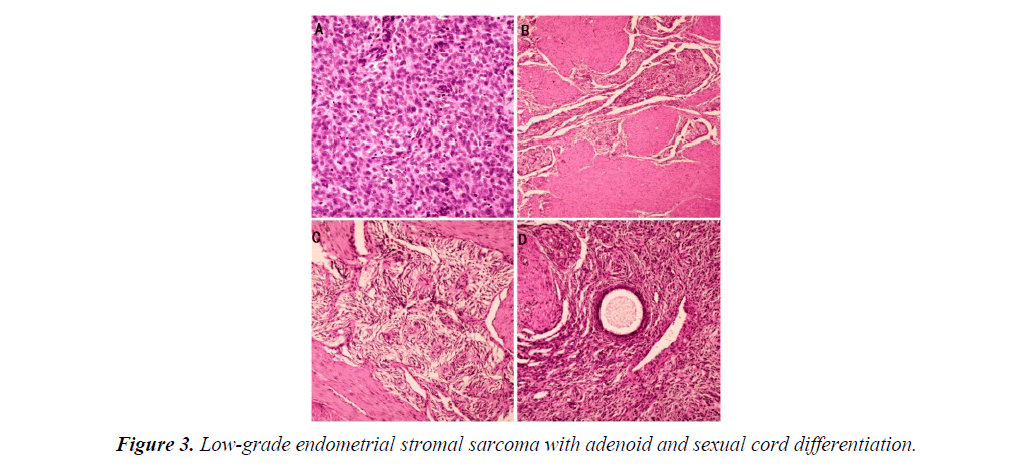 gynecology-obstetrics-low-grade-endometrial