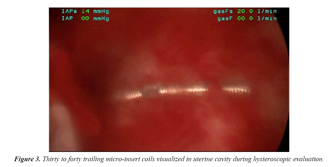 gynecology-obstetrics-micro-insert-coilsl