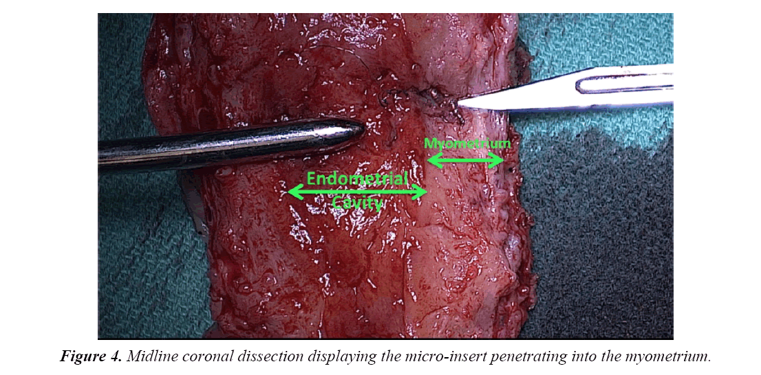 gynecology-obstetrics-micro-insert-penetrating