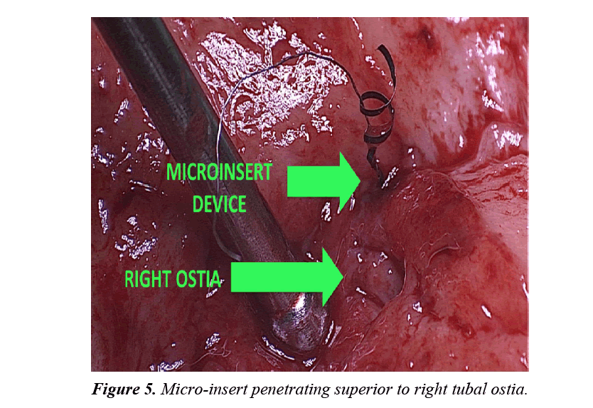 gynecology-obstetrics-right-tubal-ostia