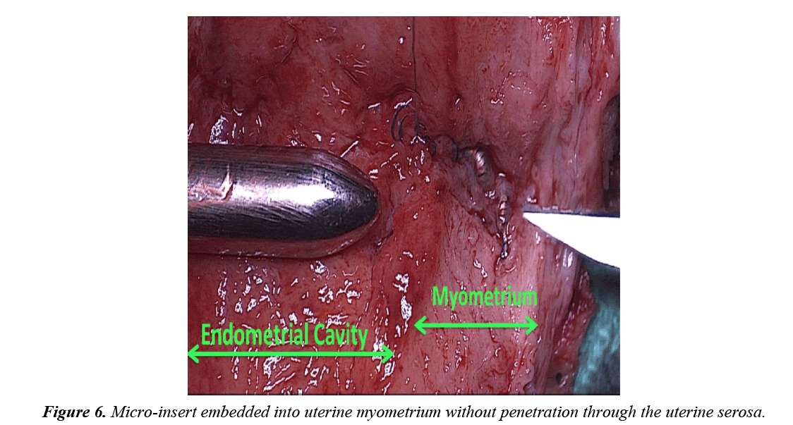 gynecology-obstetrics-uterine-myometrium