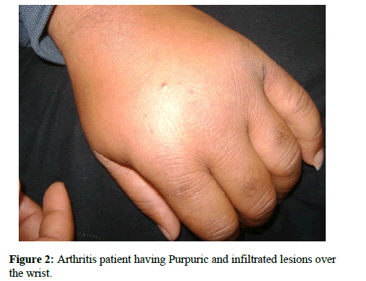 henoch schonlein purpura arthritis