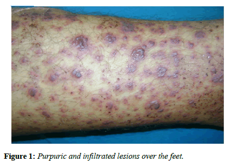 immunology-case-reports-purpuric