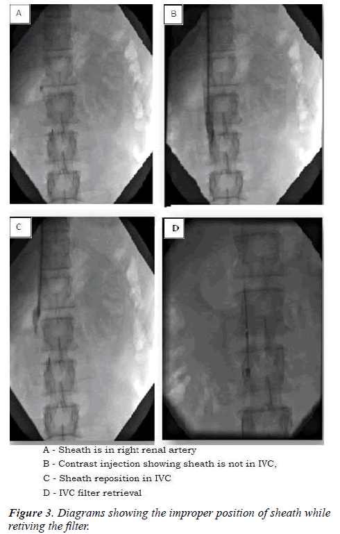 invasive-non-invasive-cardiology-sheath