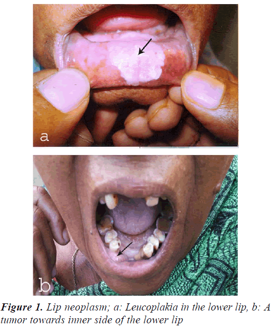 medical-oncology-therapeutics-Lip-neoplasm