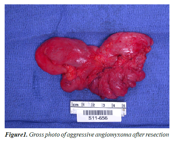 medical-oncology-therapeutics-aggressive-angiomyxoma